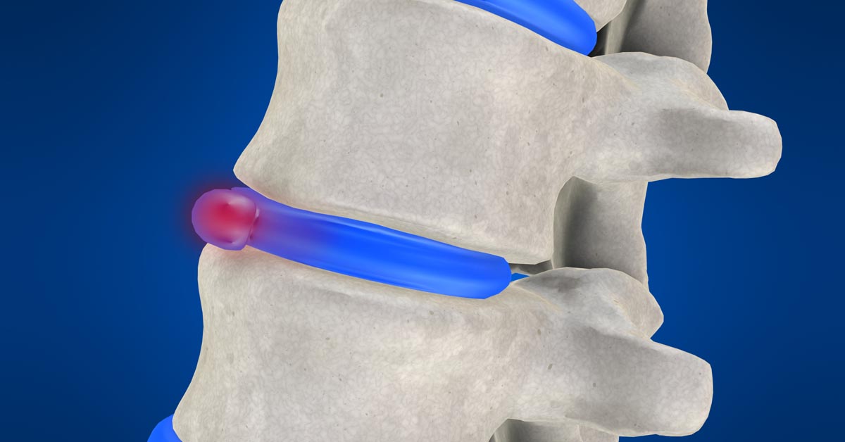 Boardman, OH non-surgical disc herniation treatment