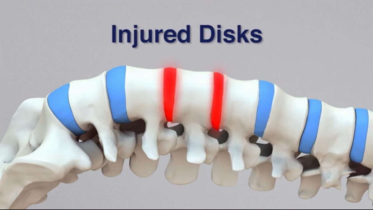 Boardman, OH non-surgical spinal decompression